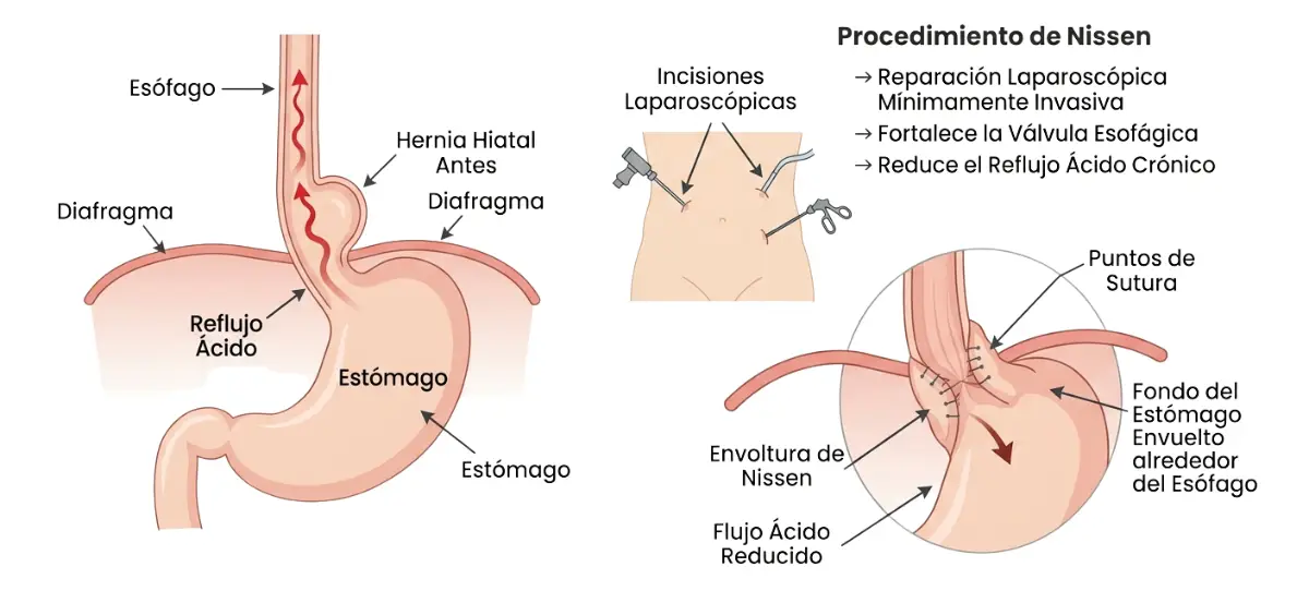 Hernia hiatal