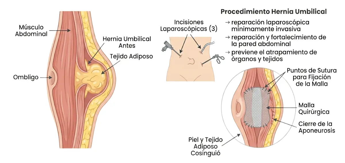 Hernia umbilical