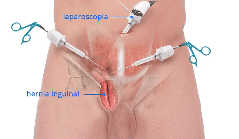 Hernia inguinal